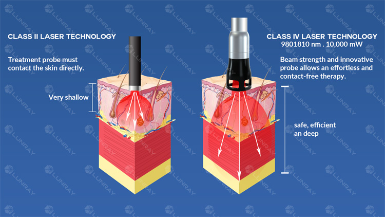 What Is the High Intensity Laser Therapy(HILT) ?