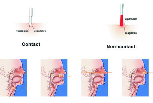 Application of Laser Light in ENT (Otolaryngology)