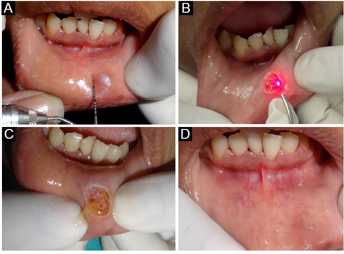 Minimally Invasive Treatment with a 980nm Diode Laser in Lingual Hemangioma